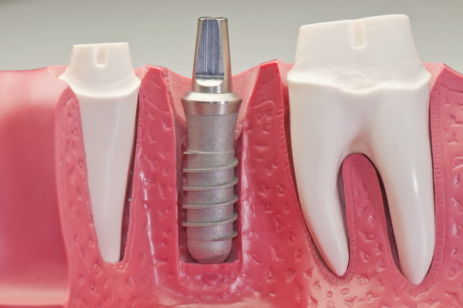 Modèle d’implant dentaire montrant comment une dent peut être remplacée