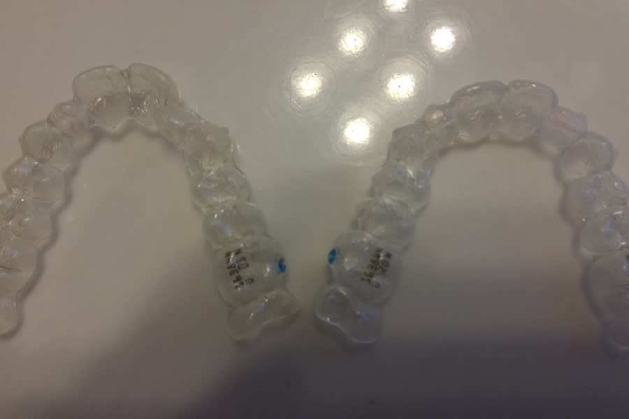 Aligneurs orthodontiques transparents utilisés pour la planification de l’alignement dentaire